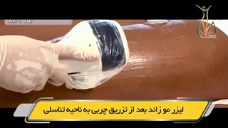 لیزر موهای زائد بعد از تزریق چربی به واژن