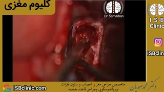 تومور گلیوم مغزی (کوروپوس کالوزوم)