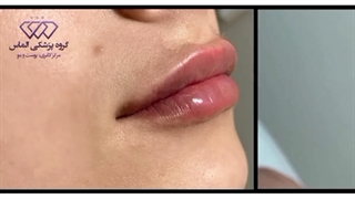 تغییر عالی لب بعد از تزریق ژل