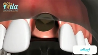 جراحی ایمپلنت دندان