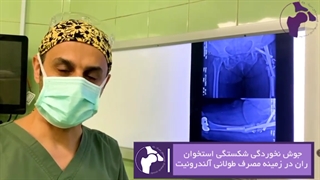 جوش نخوردن شکستگی استخوان