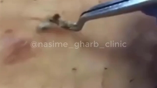 تخلیه موی زیر پوستی 2