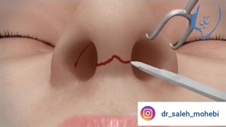 انیمیشن جراحی بینی