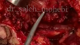 تومور با درگیری فک تحتانی