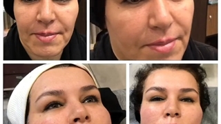 لیفت صورت با نخ