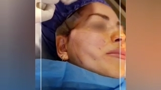 لیفت صورت با نخ
