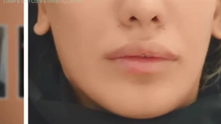 نمونه کار تزریق ژل لب
