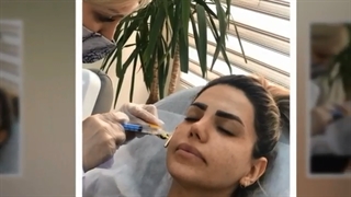 فیلم مزوتراپی صورت