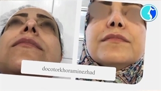 جراحی زیبایی بینی و رضایت زیباجوی عزیز