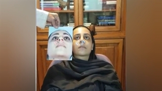 فیلم یک هفته بعد از جراحی بینی