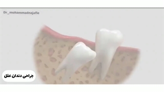 جراحی دندان عقل