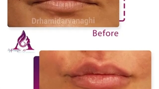اصلاح خط خنده و فیلر لب توسط دکتر حمید ارونقی