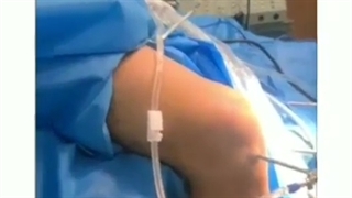 پارگی رباط ACL