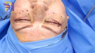 فیلم واقعی جراحی بلفاروپلاستی تحتانی