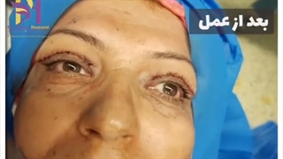 فیلم قبل و بعد از بلفاروپلاستی