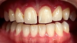 فیلم ونیر کامپوزیت