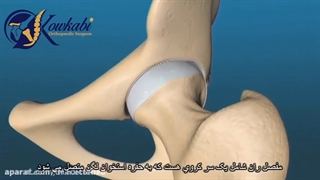 عمل جراحی تعویض مفصل لگن چگونه انجام می شود؟