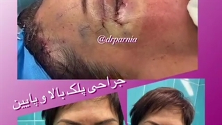 جراحی پلک بالا و پلک پایین