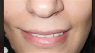 اجرای ۱۰ واحد روکش گلس سرامیک برای مراجعه کننده