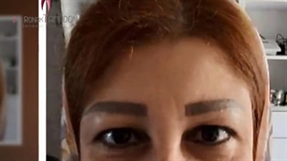 عمل بلفاروپلاستی پلک