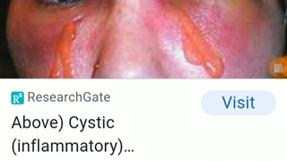 گرانولوما تشخیص و درمان .دکتر مقیمی www.ebiderm.blogfa.com