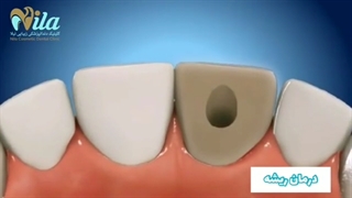 درمان ریشه دندان