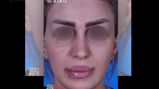 عمل رینوپلاستی بلافاصله پس از عمل