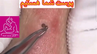 تخلیه جوش چرکی