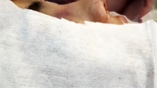 اصلاح نوک و قوز بینی در اتاق عمل