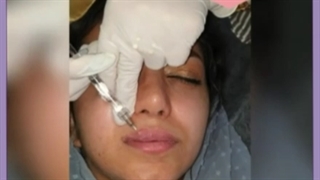 تزریق ژل لب کاملا طبیعی در بهترین کلینیک اصفهان
