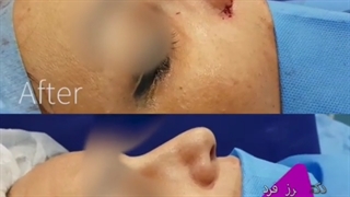 فیلم واقعی عمل بینی