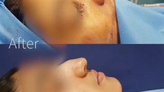 فیلم واقعی و بدون سانسور اتاق عمل، جراحی بینی استخوانی