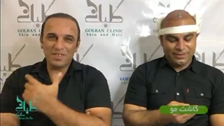 کاشت مو در تهران