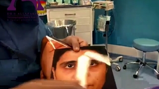 لیفت اندوسکوپیک پیشانی و ابرو