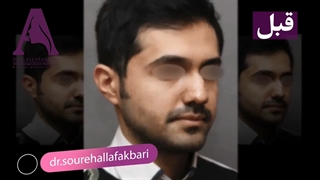 شش ماه بعد از بازسازی بینی