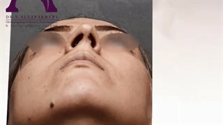 قبل و بعد از عمل زیبایی بینی