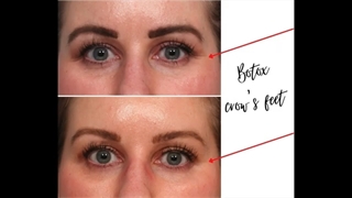 تزریق فیلر |