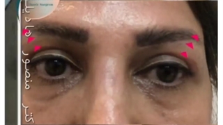 بلفاروپلاستی