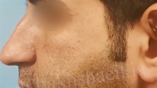 جراحی زیبایی بینی