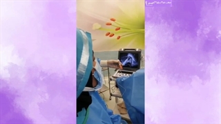 پانکچر تخمدان در IVF
