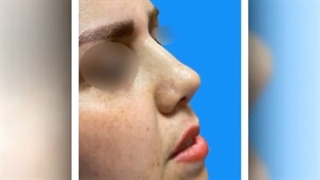 جراحی زیبایی بینی