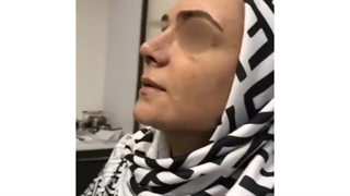 فیلم عمل زیبایی بینی