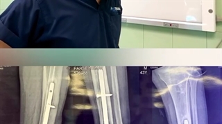 جوش نخوردن استخوان به دلیل عفونت