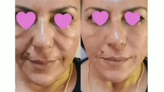 فیلم تزریق مزوژل برای جوانسازی صورت
