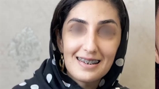 تغییر جذاب یک دختر زیبا بعد از جراحی فک