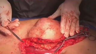 خارج سازی تومور