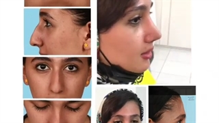یک ماه بعد جراحی زیبایی بینی استخوانی