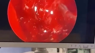 جراحی تومور هیپوفیز