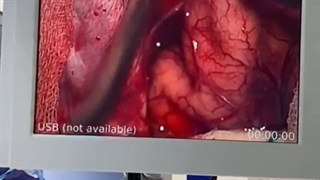 مننژیومای فالکس سربری