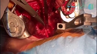 جراحی فیکساسیون قدامی_خلفی دیسک گردن